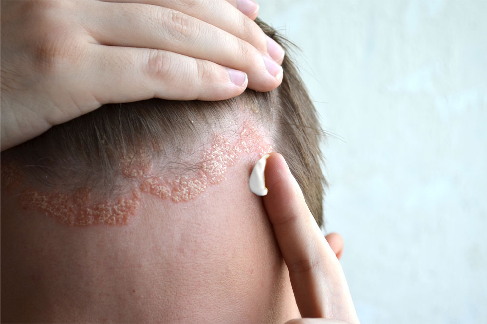 Essential factors linked to scalp psoriasis