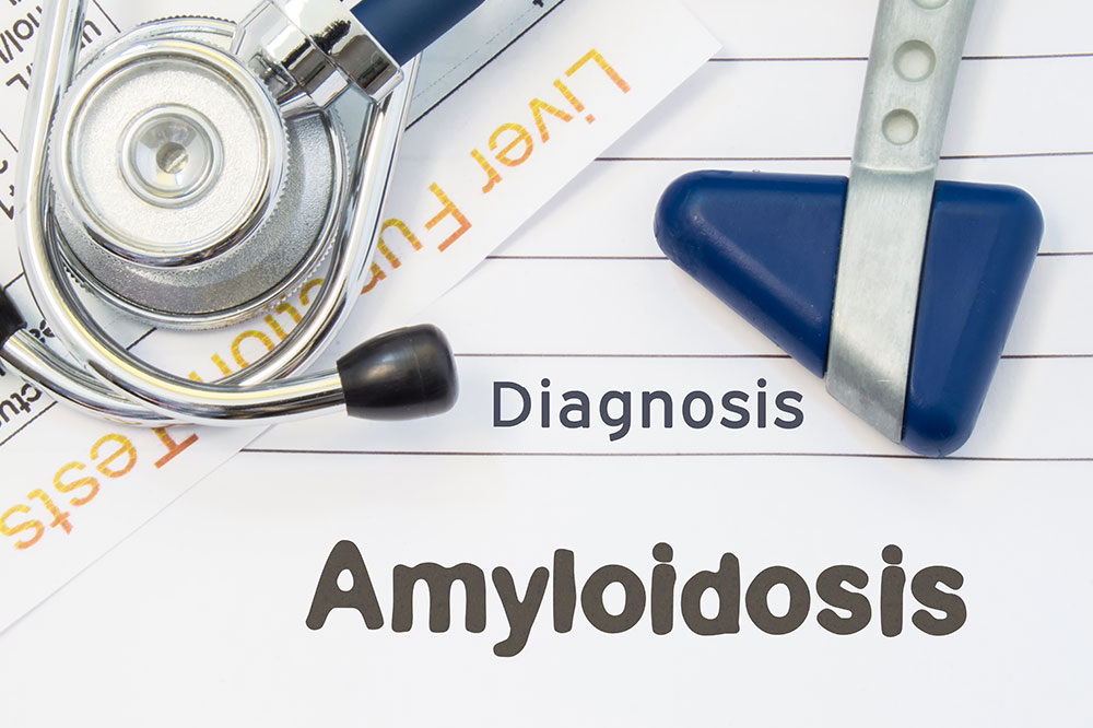 Amyloidosis – Its symptoms, causes, diagnoses, and treatments
