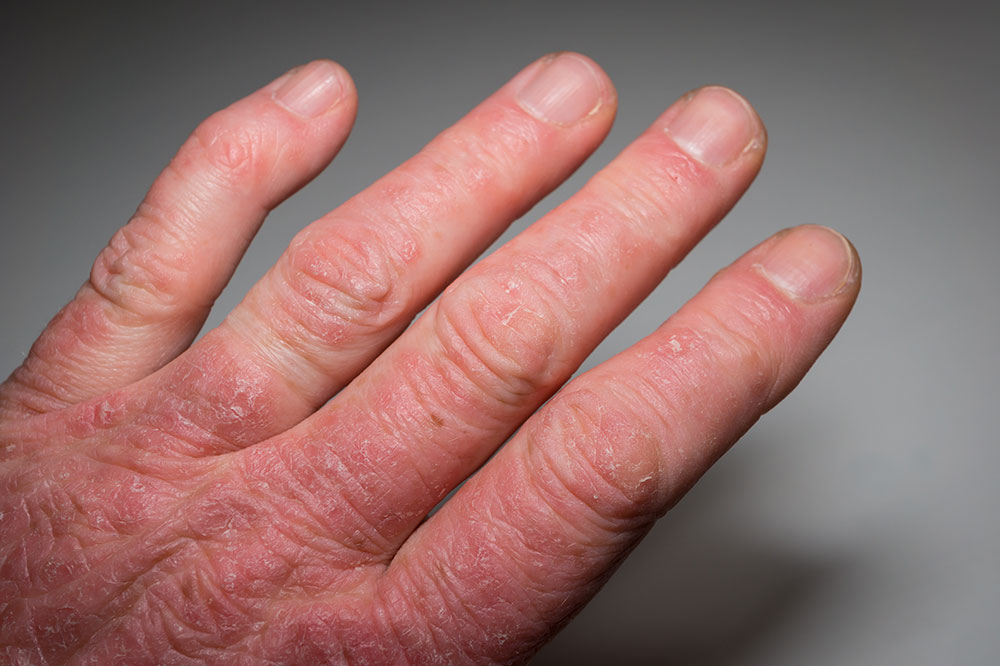 Psoriatic arthritis – symptoms, causes, diagnosis, and treatment