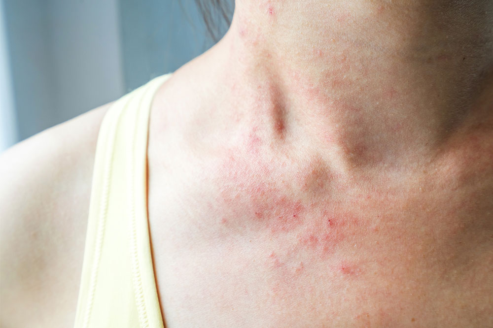 Skin rashes – Everything there is to know