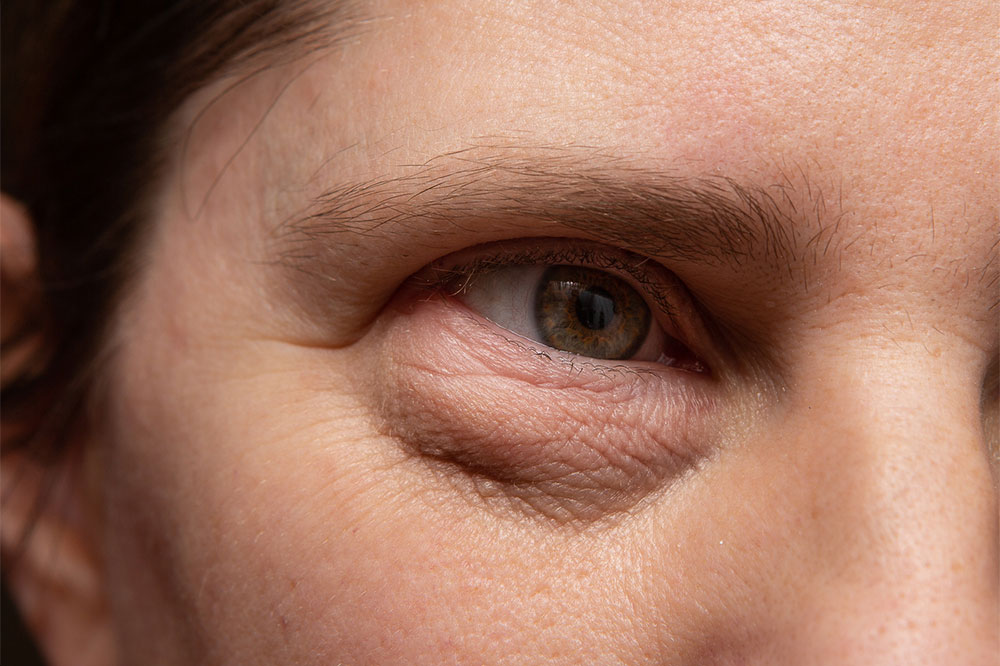 9 benefits of undergoing a blepharoplasty procedure