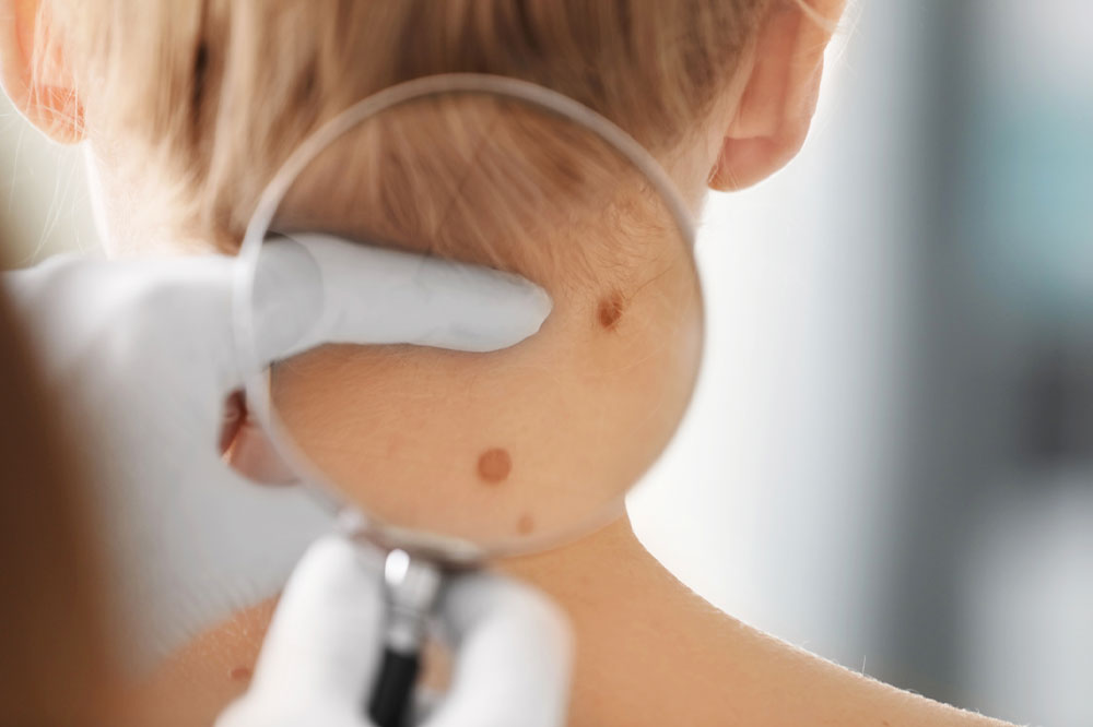 Melanoma – Causes, signs, and management