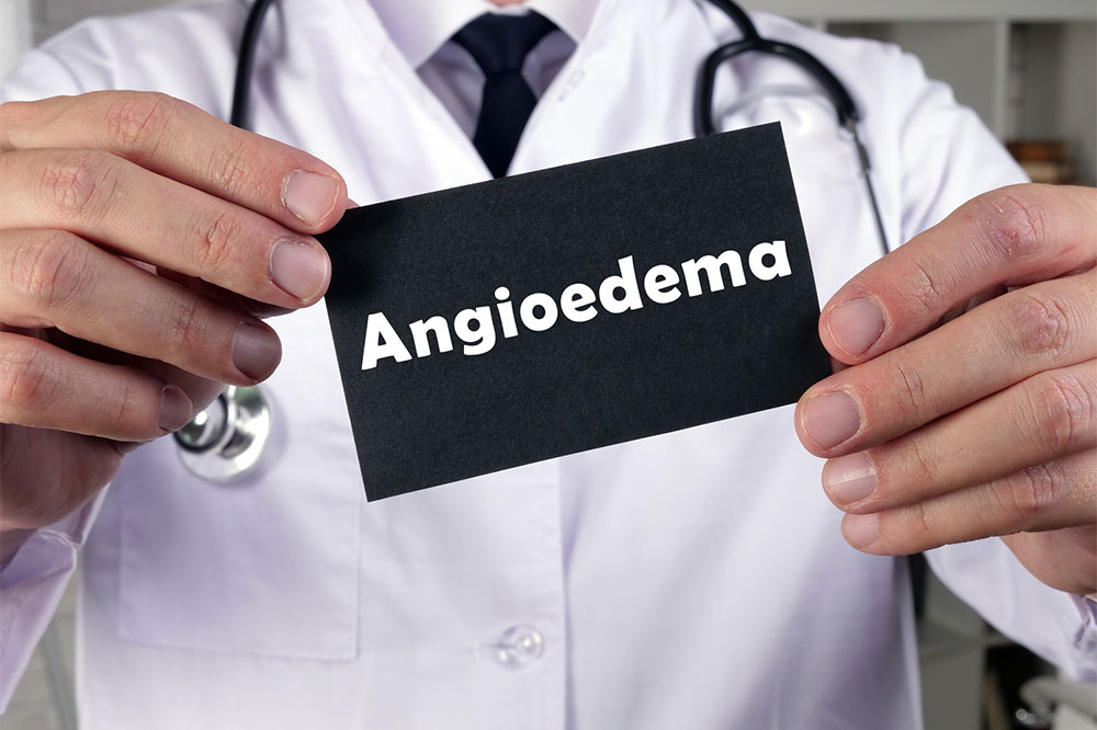 Common and not-so-common signs of angioedema