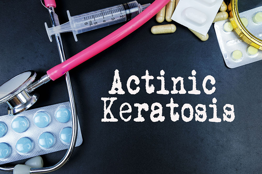 Actinic keratosis – Signs, causes, diagnosis, and management
