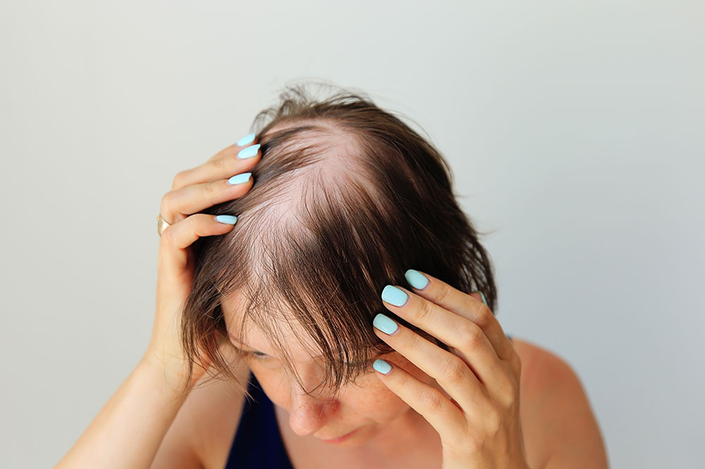Alopecia areata – Symptoms, causes, and management options
