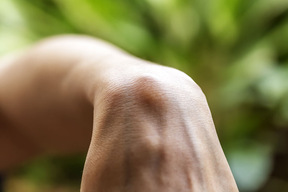 Bible cyst – Causes, symptoms, and prevention