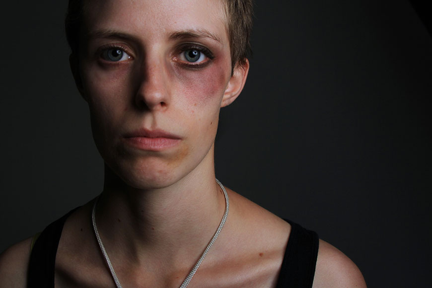 Black eye – Signs, causes, and management