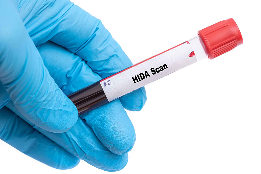 HIDA scan – Things to know about the procedure