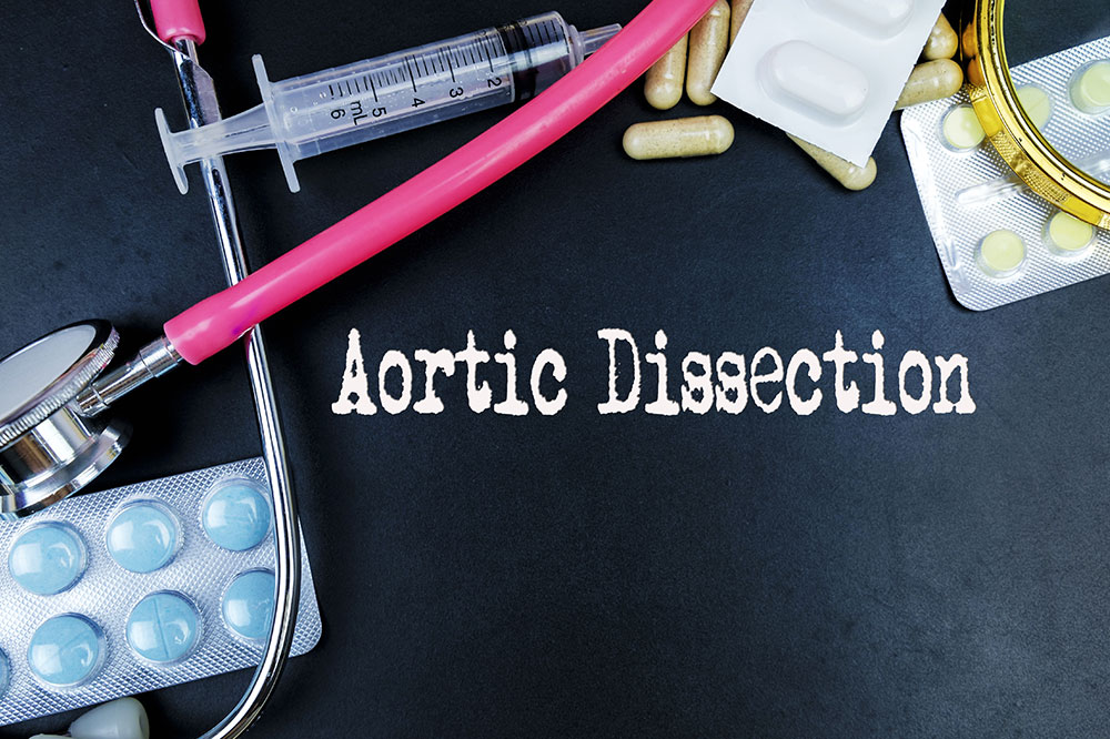 Key factors to know about aortic dissection