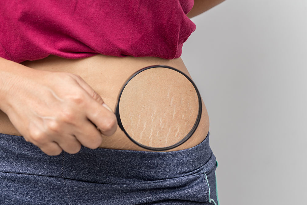 Managing stretch marks – Remedies and techniques to remember